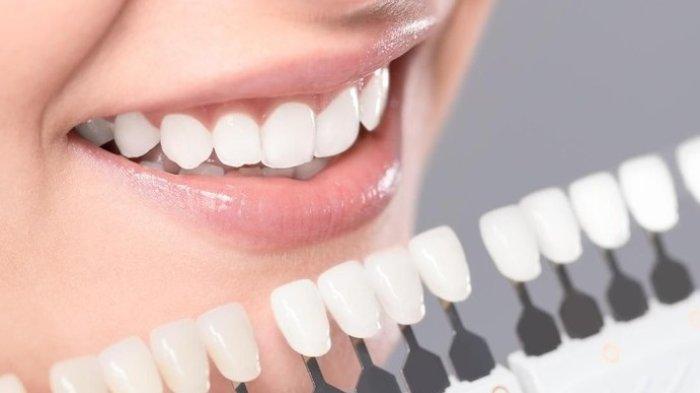 Tren Veneer Gigi, Benarkah Bisa Picu Bau Mulut?_trends.co.id