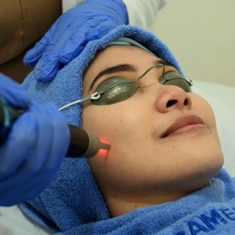 PicoSure Pro, Solusi Terkini untuk Melasma dan Masalah Kulit Lain Tanpa Downtime_trends.co.id